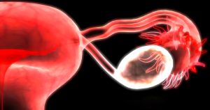 Lão hóa buồng trứng sớm: nguy cơ sẩy thai & cơ hội mang thai nhờ kỹ thuật hỗ trợ sinh sản