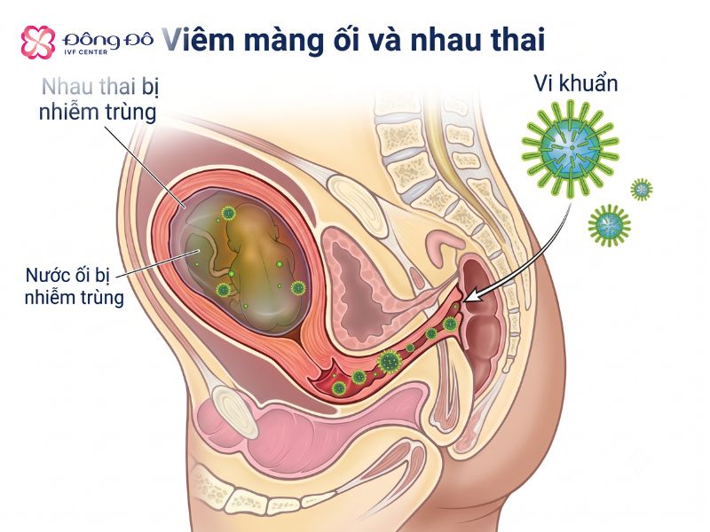 Trường hợp viêm màng ối sẽ không thể thực hiện khâu eo cổ tử cung