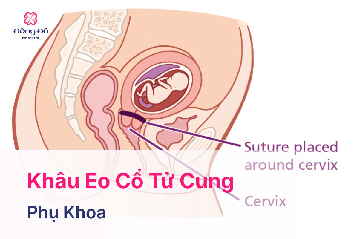 Khâu Eo Cổ Tử Cung Dự Phòng Sinh Non Và Sảy Thai Liên Tiếp