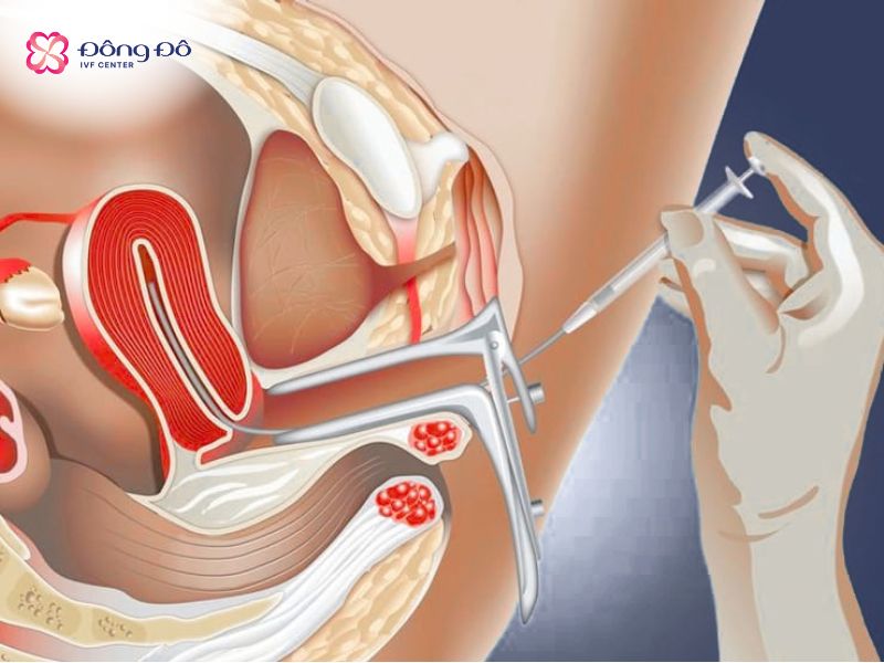 Hình ảnh minh họa kỹ thuật chuyển phôi