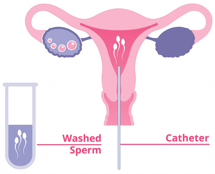 Bước cuối của quy trình thụ tinh nhân tạo bác sĩ sẽ tiến hành bơm tinh trùng vào tử cung
