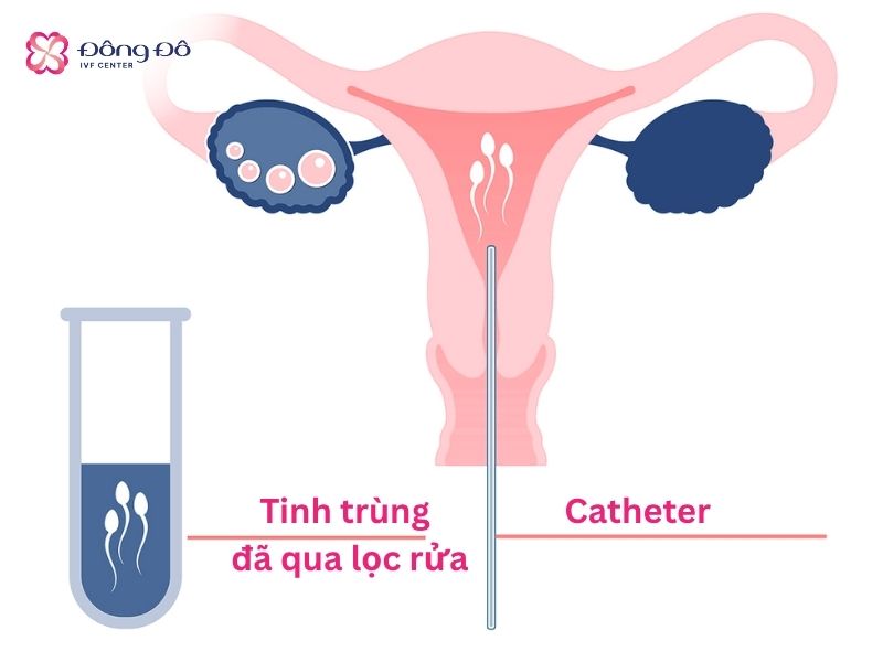 Hình ảnh minh họa quá trình bơm IUI