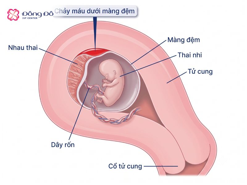 Hình ảnh minh họa thai tụ dịch màng nuôi