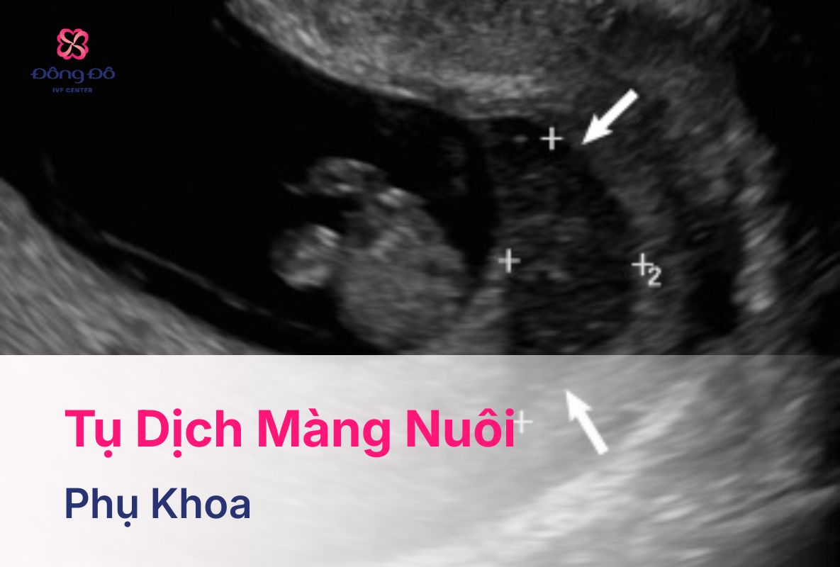 Tụ Dịch Màng Nuôi Ảnh Hưởng Như Thế Nào Đến Việc Mang Thai?