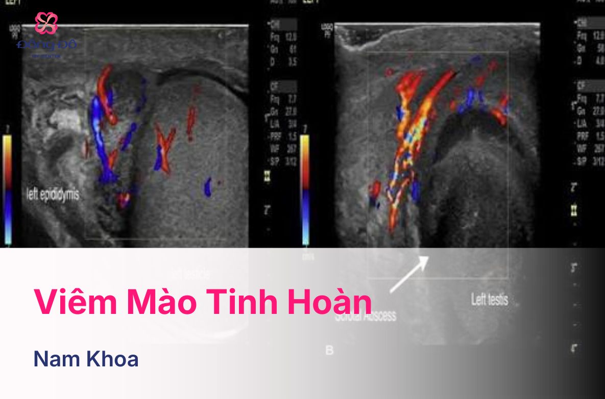 Viêm Mào Tinh Hoàn: Nguyên Nhân, Dấu Hiệu, Chẩn Đoán Và Điều Trị