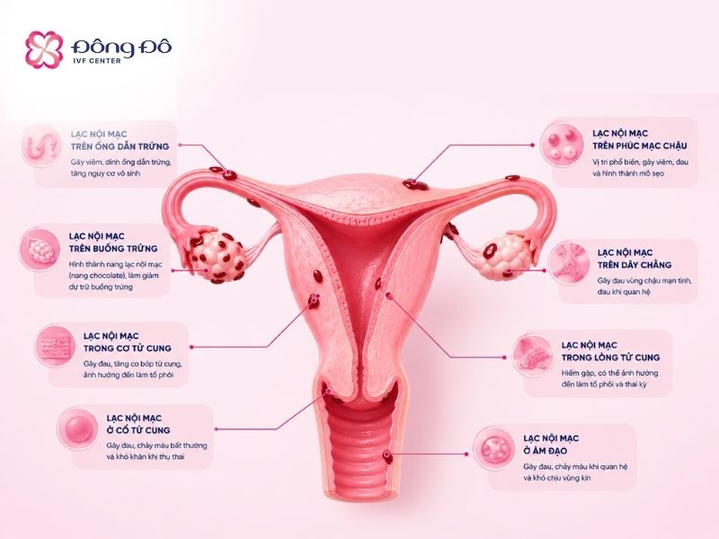 Bệnh lý lạc mội mạc tử cung cần được điều trị trước khi làm IVF