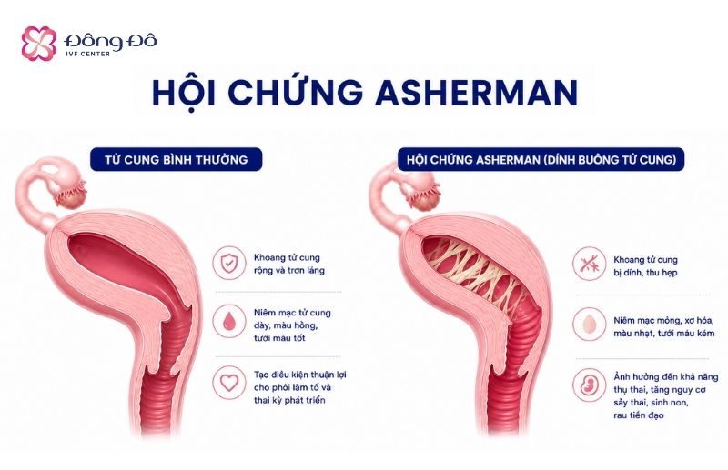 Hội chứng Asherman làm giảm độ dày tử cung