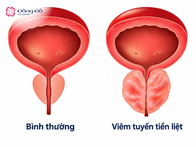 Hình ảnh minh họa viêm tuyến tiền liệt