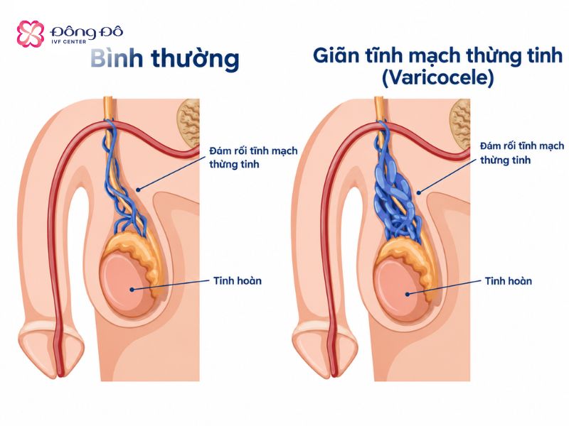 Hình ảnh minh họa giãn tĩnh mạch thừng tinh