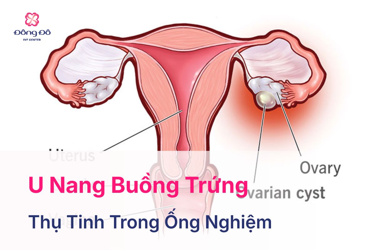 U Nang Buồng Trứng Là Gì? Dấu Hiệu, Triệu Chứng Và Lưu Ý