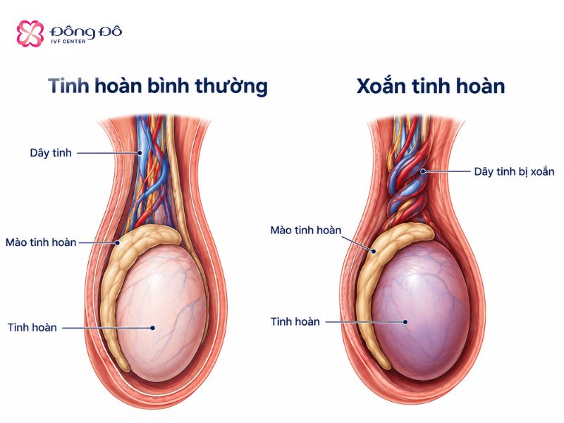 Xoắn tinh hoàn gây đau đột ngột và dữ dội, cần được điều trị kịp thời
