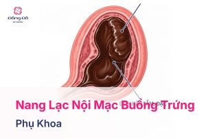 Nang Lạc Nội Mạc Buồng Trứng Là Gì? Có Nguy Hiểm Không?