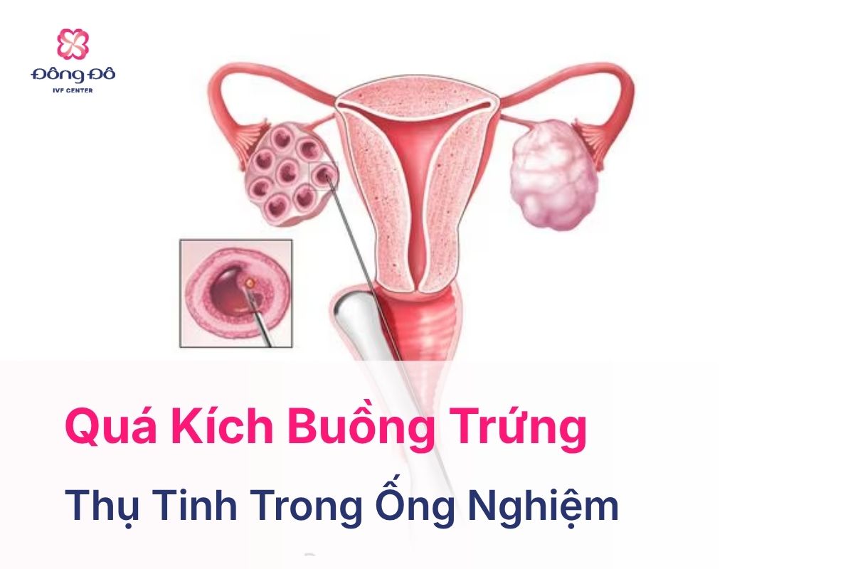 Quá Kích Buồng Trứng: Hiếm Gặp Nhưng Không Thể Chủ Quan
