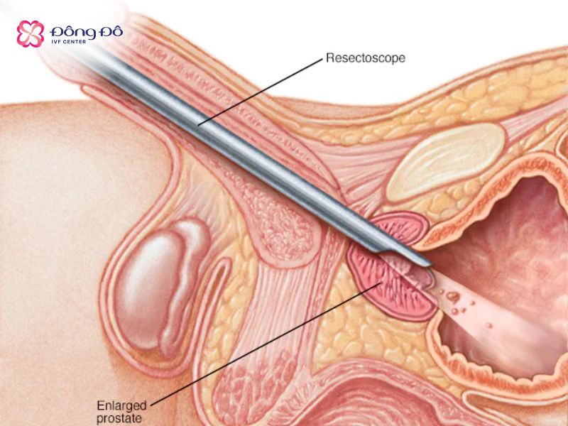 Hình ảnh minh họa Cắt đốt tuyến tiền liệt qua niệu đạo (TURP)