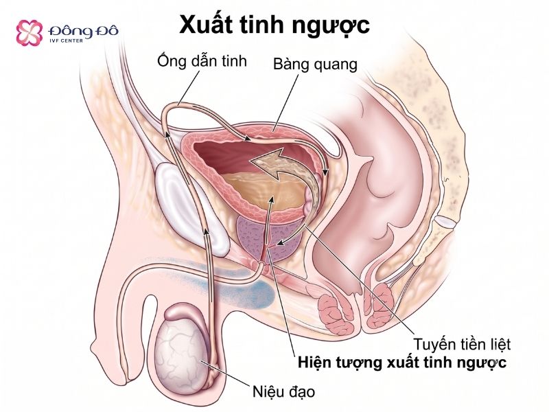 Hình ảnh minh họa xuất tinh ngược dòng